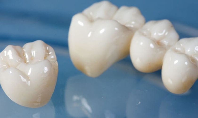 Dental Crowns in Matthews NC