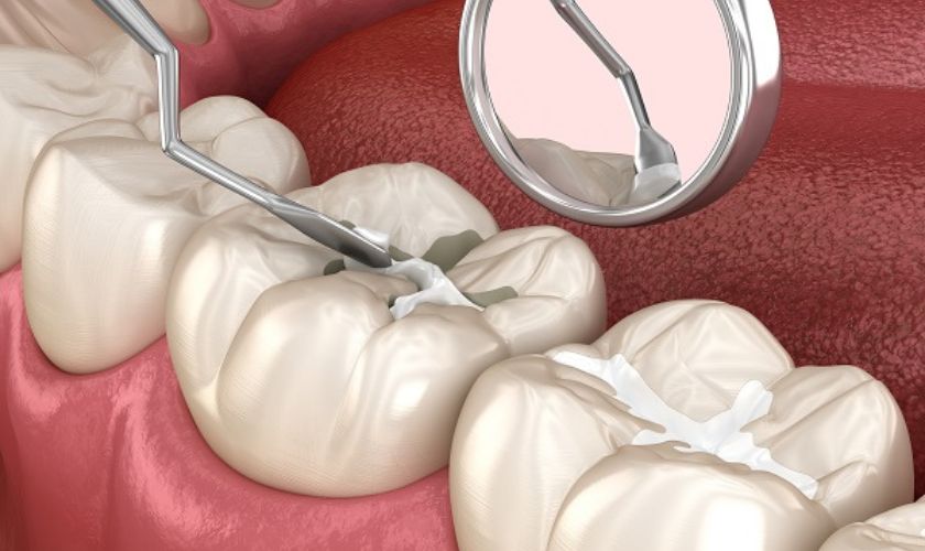 Tooth-Colored Fillings: Cavity Filling with Aesthetic Appeal