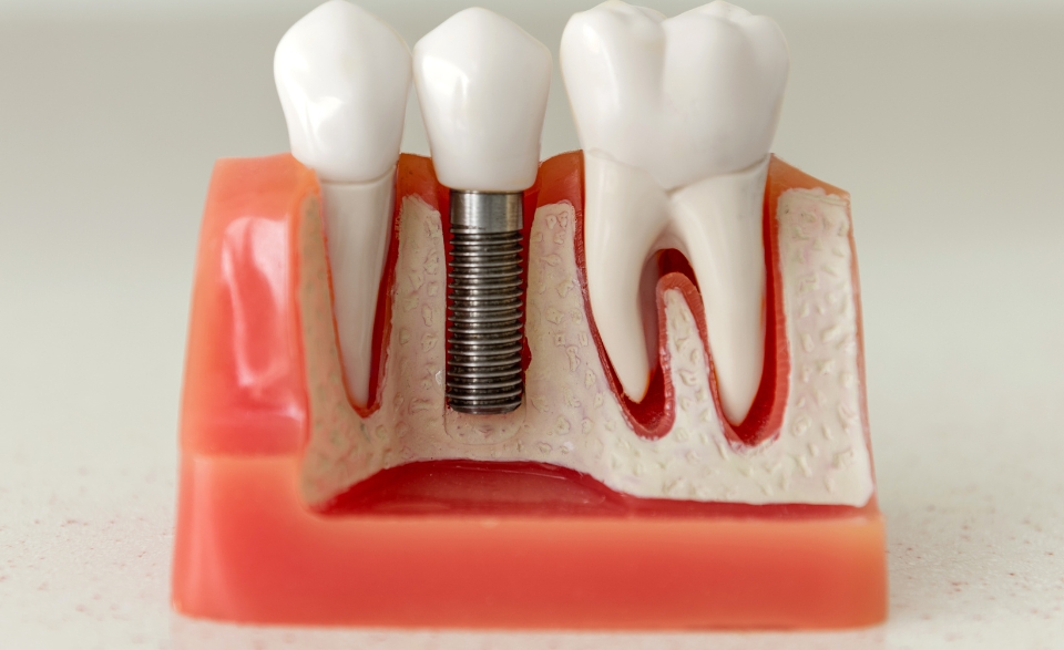 Guidance for a Shift from Dentures to Dental Implants