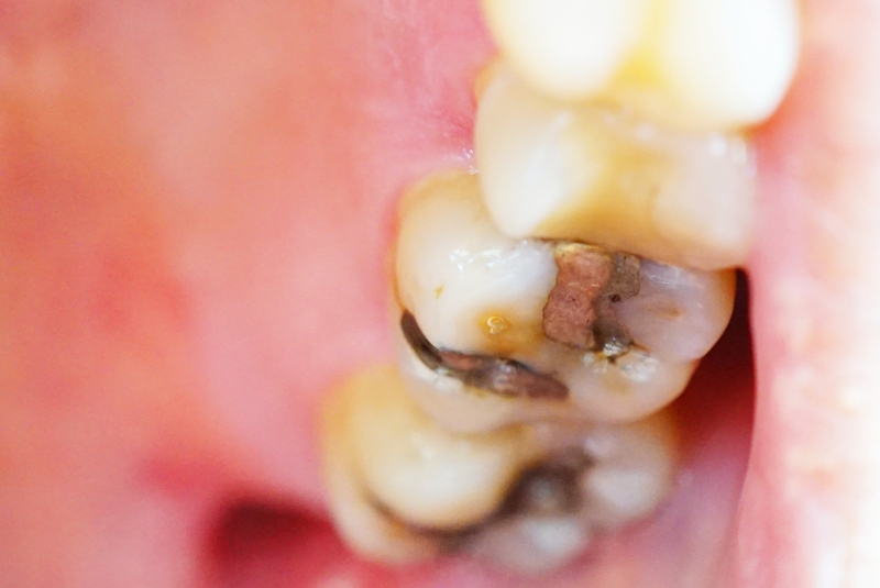 How Long Should A Dental Filling Last