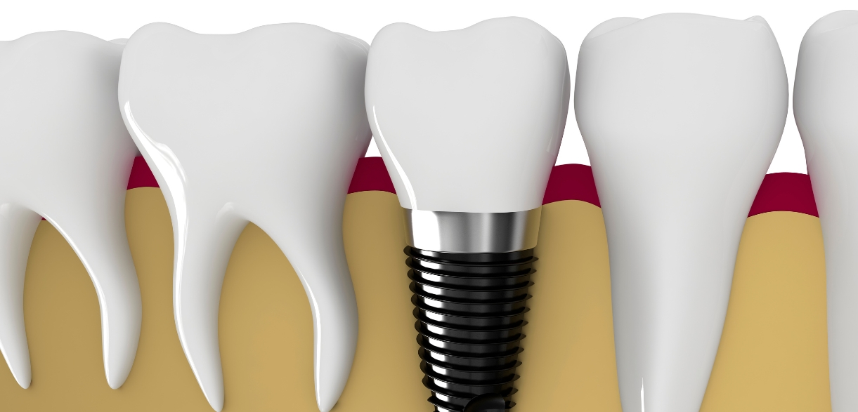 dental implants in rheumatoid arthritis patients