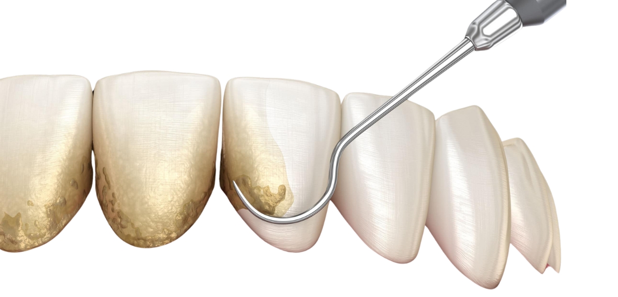 seven causes of black spots on teeth