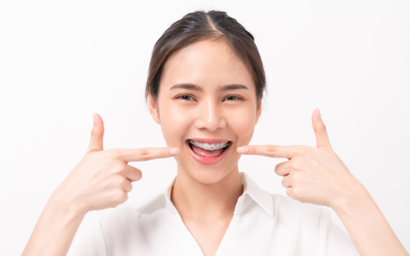whitening your teeth is possible even if you have bonding