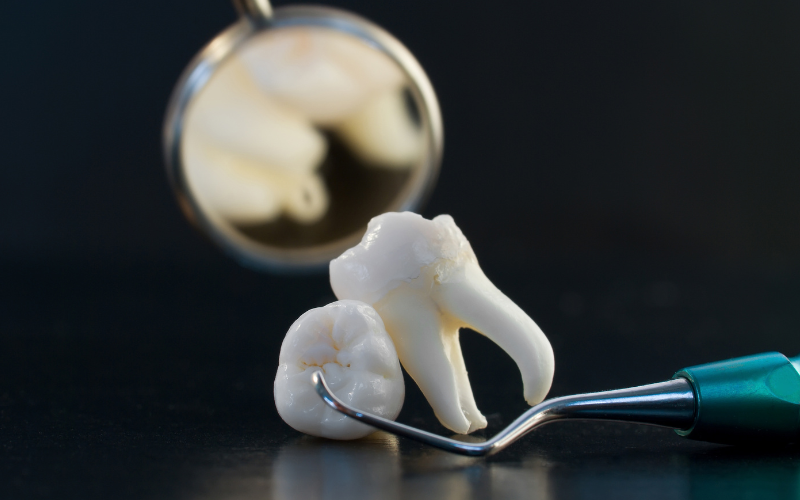 Tips to Avoid Infection & Speed Up Healing After Wisdom Teeth Extraction