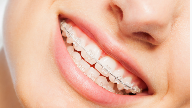 What to Do if a Bracket or Wire Breaks