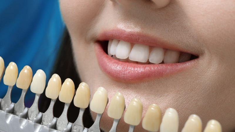 most common reasons your veneers need replacement