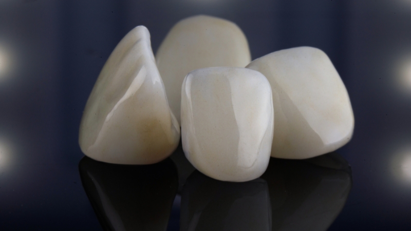 essential tips for long-lasting veneers