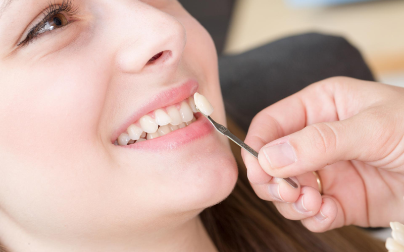 Veneers For Stained or Discolored Teeth