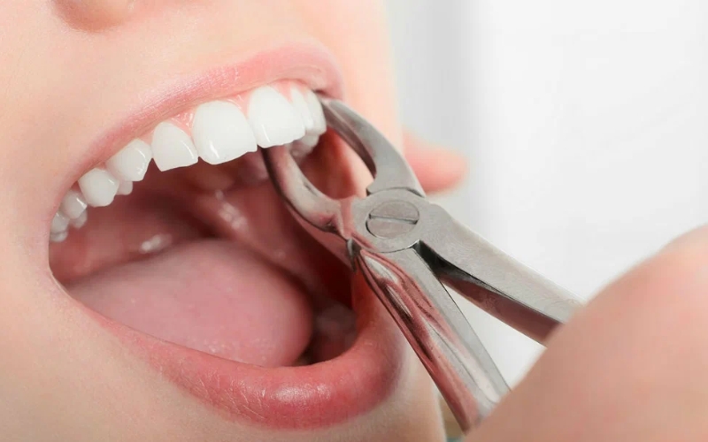 Modern Dentistry For Painless Tooth Extractions