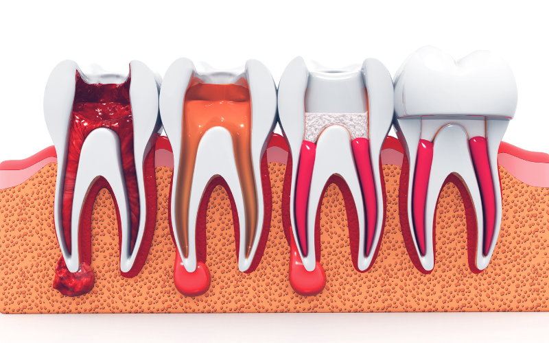 How Dentist Makes Root Canal Treatments Stress-Free