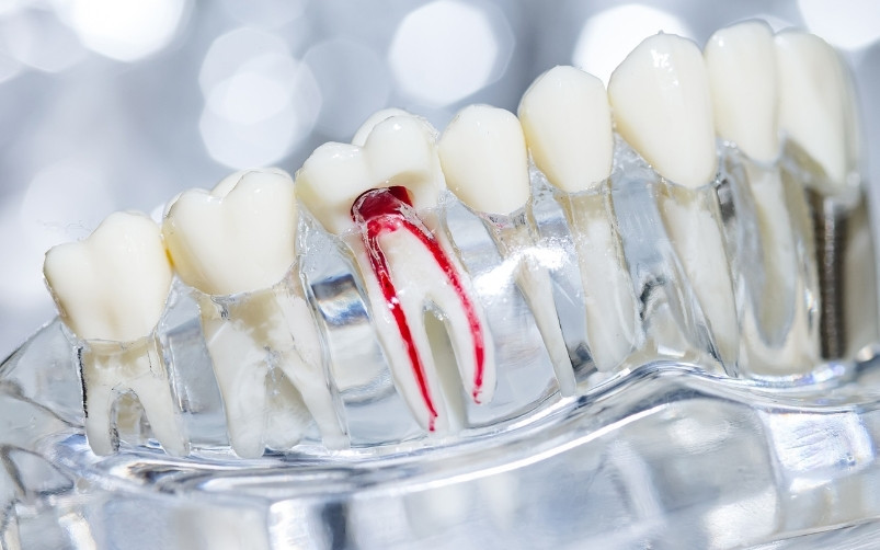 professional tips to stay calm during root canal