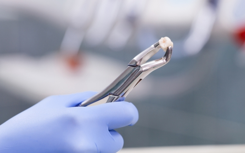 top reasons for tooth extraction