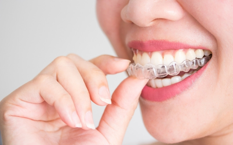 7 important facts about Invisalign