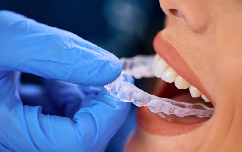 Featured image for “How Long Does It Take to Close Gaps in Teeth with Clear Aligners?”