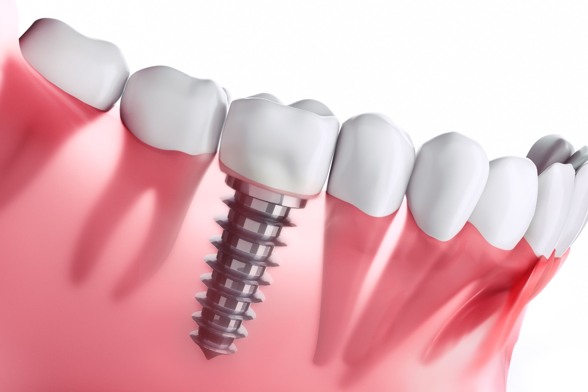 Featured image for “Maintaining Your Dental Implants: A Long-Term Care Guide”