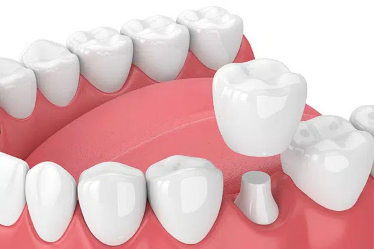 Featured image for “How to Know When Your Dental Crown Needs Replacement”
