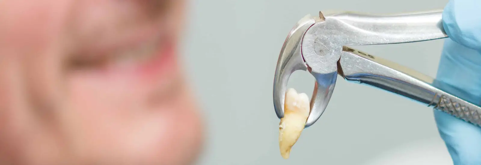 tooth extraction in matthews