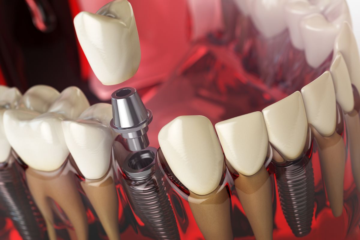 Featured image for “Who Is a Good Candidate for Dental Implants?”