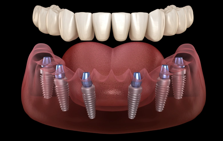 What is All-on-X Full Arch Restoration?