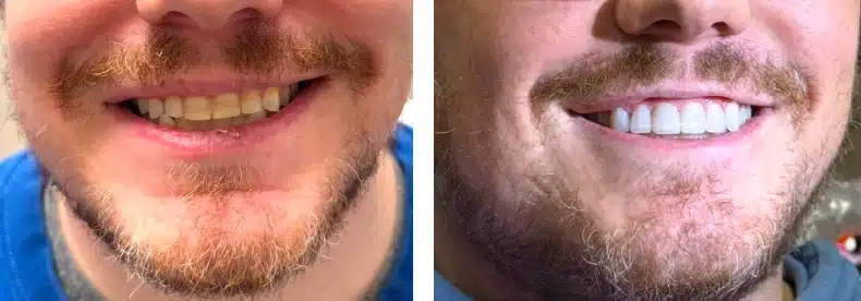 Neer Results Teeth Whitening