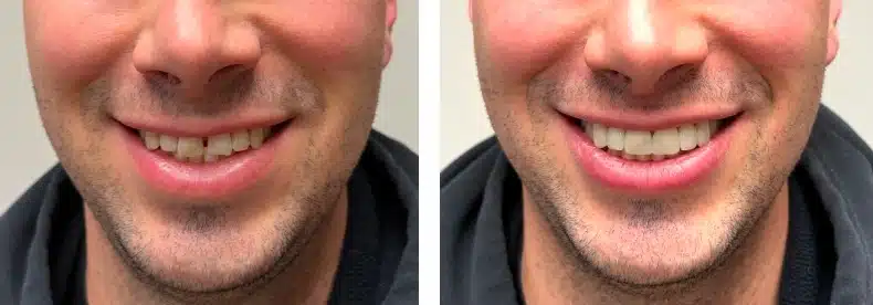 Neer Results veneers