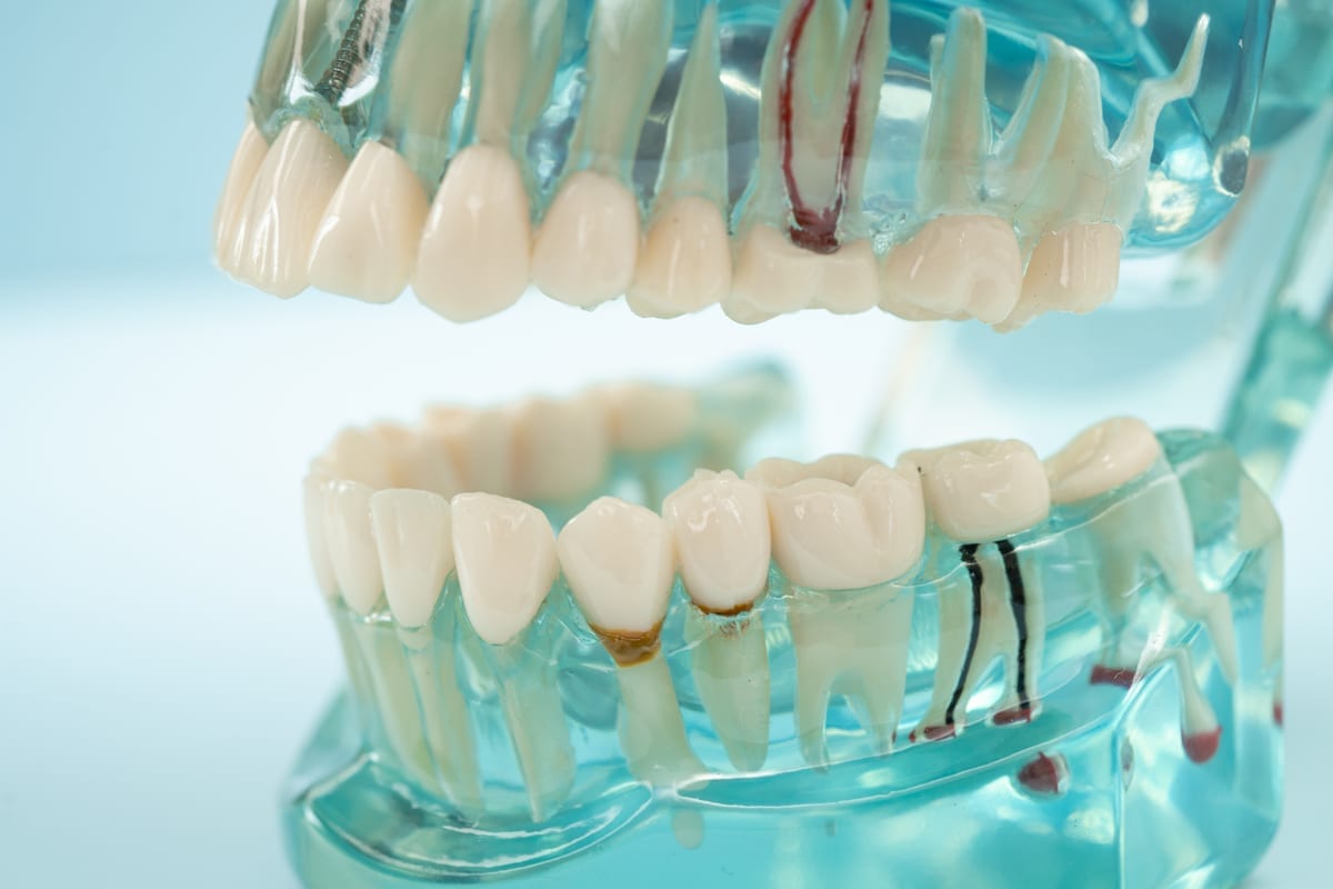 Featured image for “Root Canal Pain & Anesthesia in Matthews, NC”