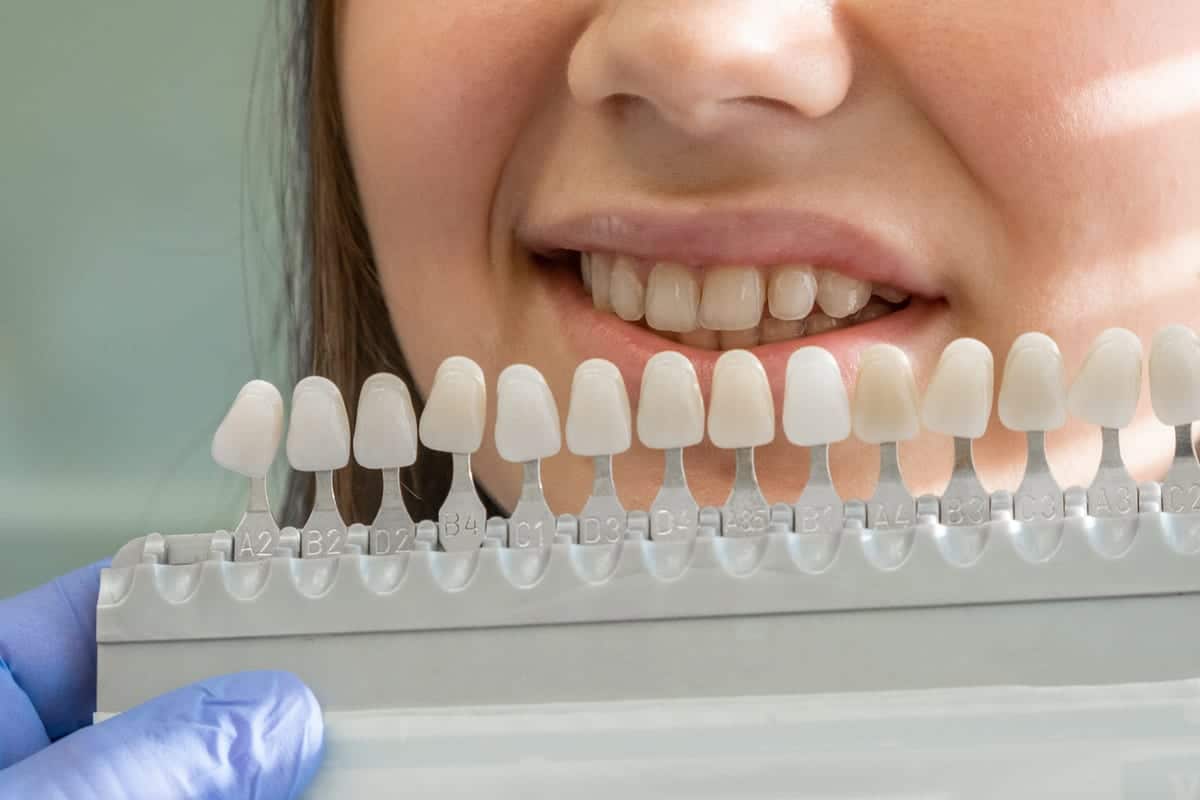 Featured image for “Veneers vs. Bonding in Matthews, NC | Dawson Modern Dentistry”